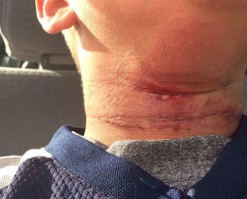 A photo of a Black child in a car who had a noose around his neck, and rope burns are present