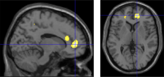 A photo of imaging of a brain. There are a few yellow spots on the brain.