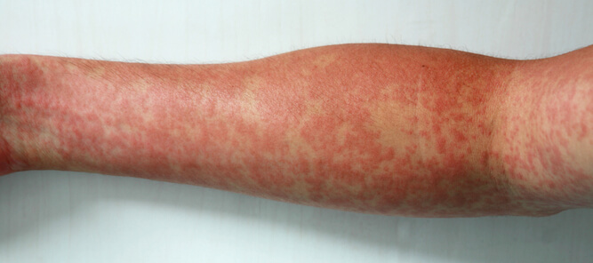 A photo of someone's arm who has measles