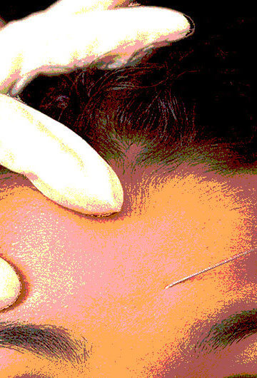 Black woman with a botox needle being injected into her forehead